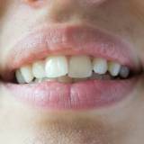 denti accavallati