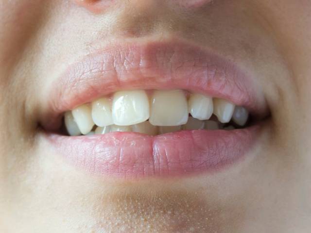 https://studicampagna.it/wp-content/uploads/2025/06/denti-accavallati-112-640x480.jpg