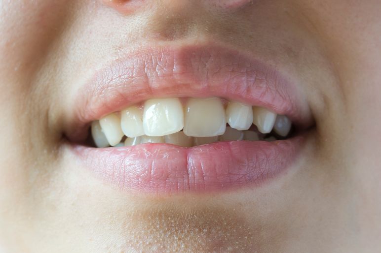 denti-accavallati-112.jpg