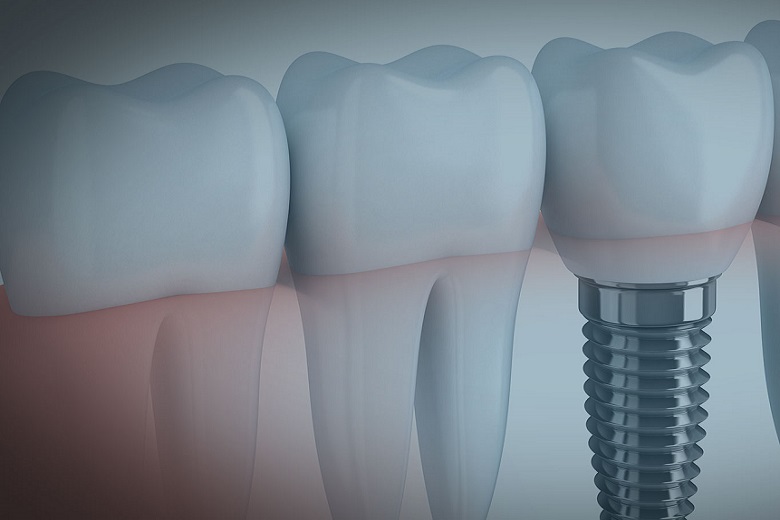 Implantologia: quando il dente va curato e quando va sostituito