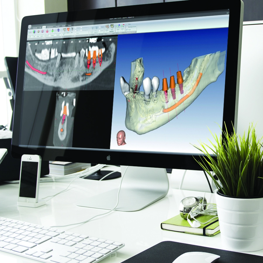 Implantologia computer guidata