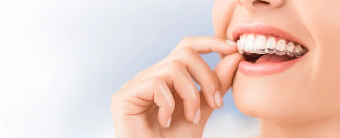 Ortodonzia invisibile a Catania