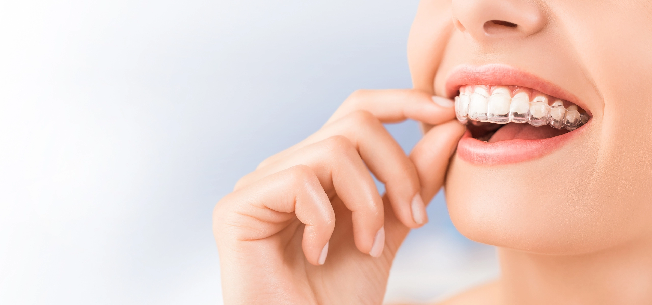 Ortodonzia invisibile