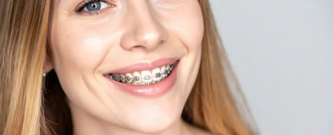 Ortodonzia linguale a Catania