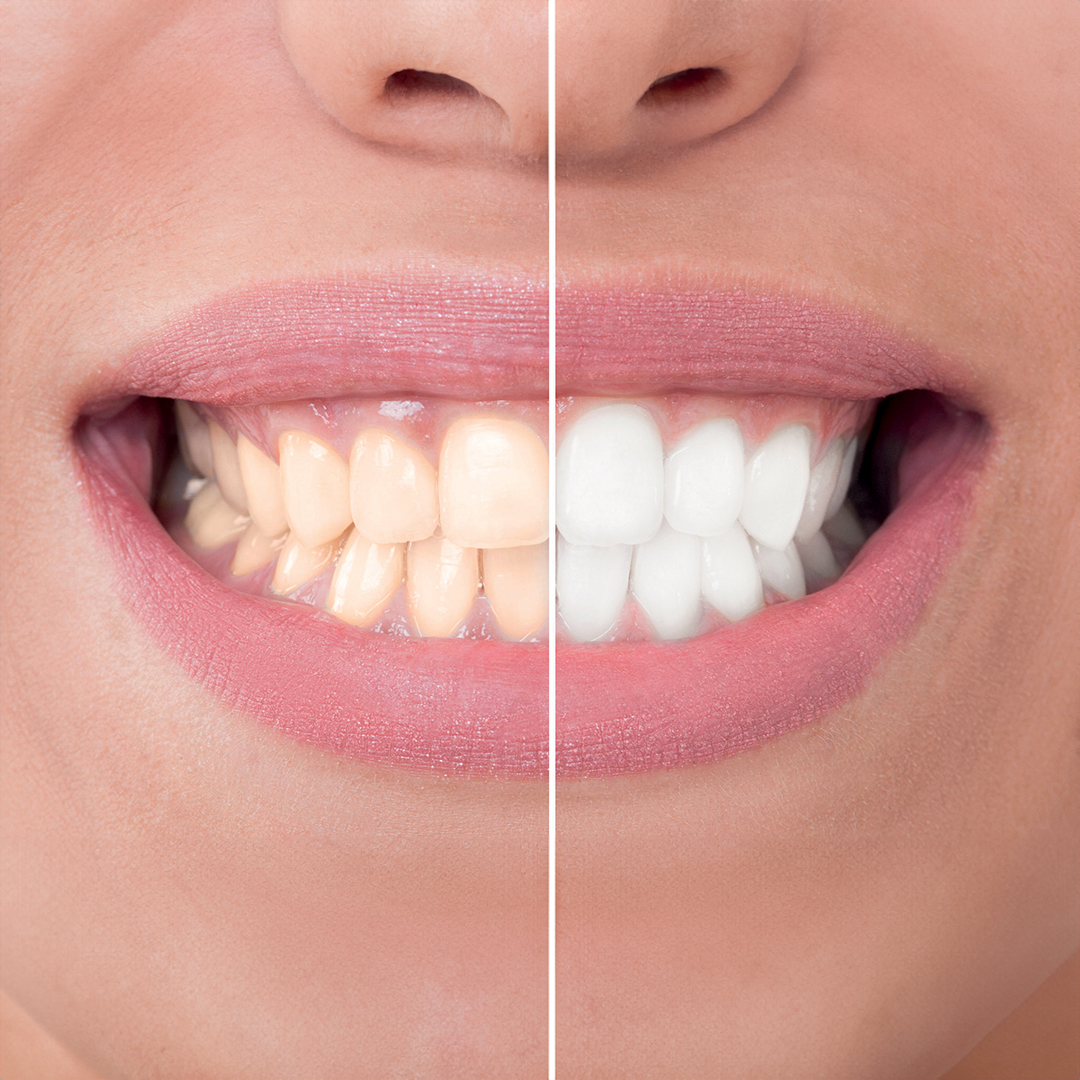 Sbiancamento dentale a Catania