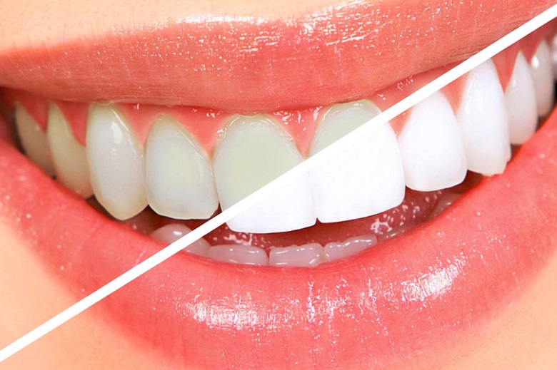 Ecco i 4 cibi che aiutano a mantenere i denti bianchi