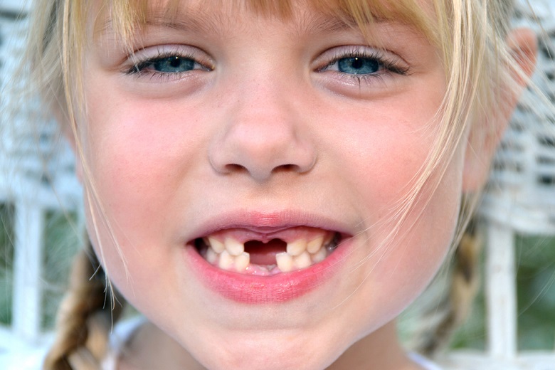 Denti da latte neri: quali sono le cause e come prevenire