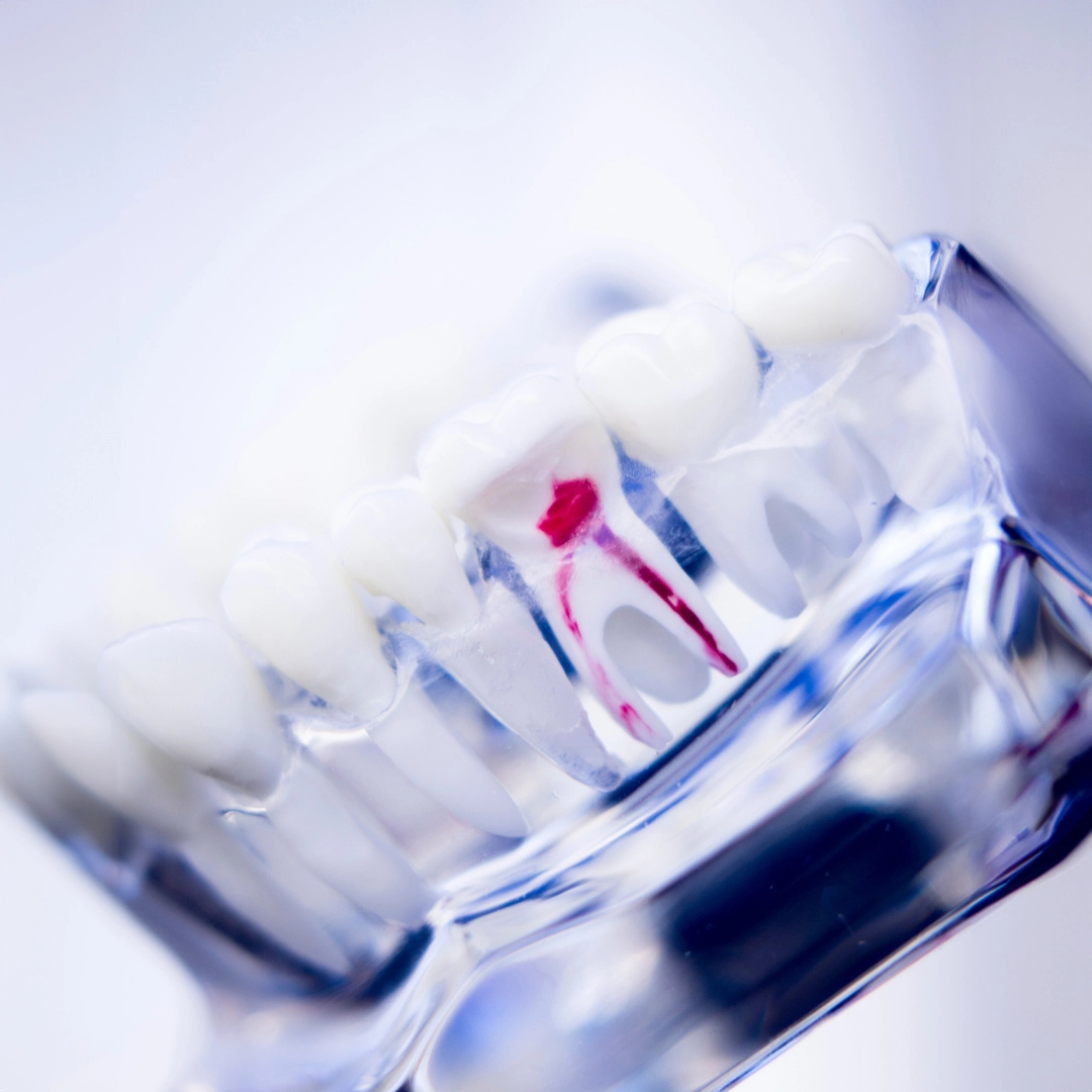 devitalizzazione dente