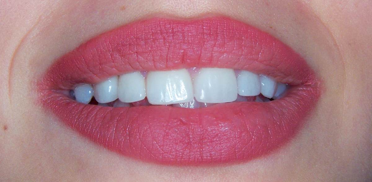 faccette dentali dopo