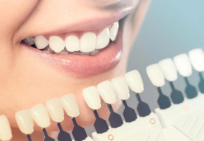 3 cose che dovresti sapere sull’uso delle faccette dentali