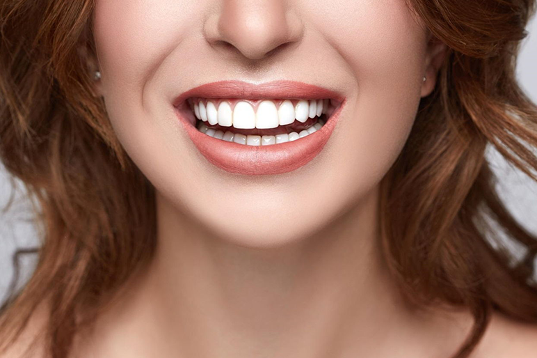 Faccette dentali: tutto quello che devi sapere