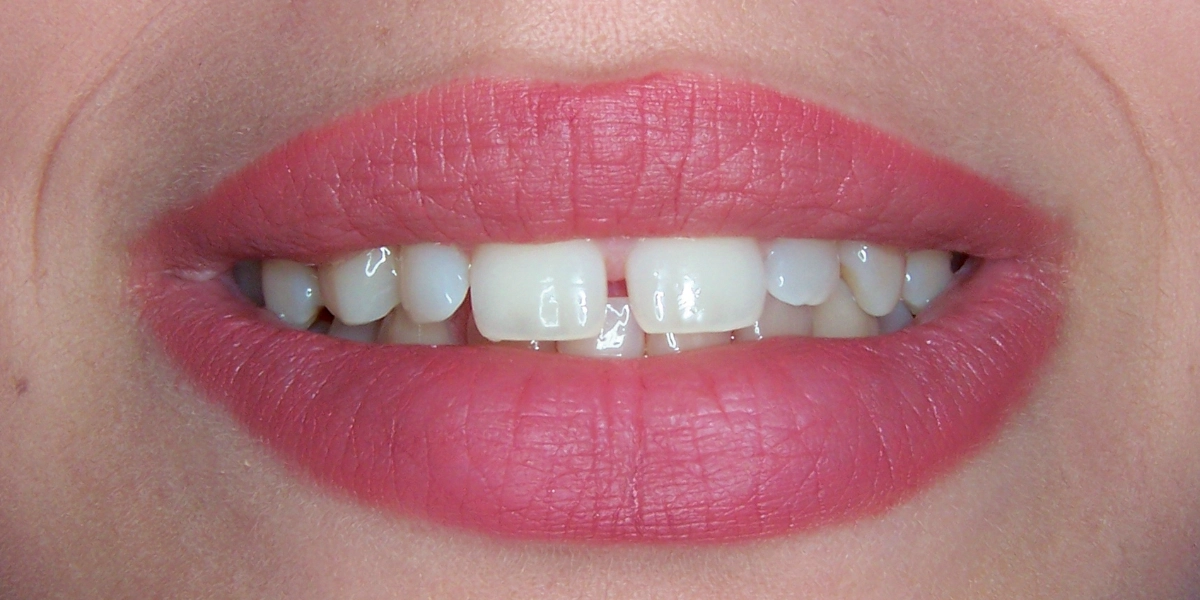 faccette dentarie prima