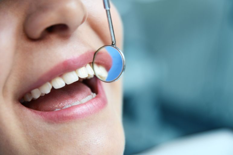 Macchioline nere sui denti: cosa sono e come eliminarle