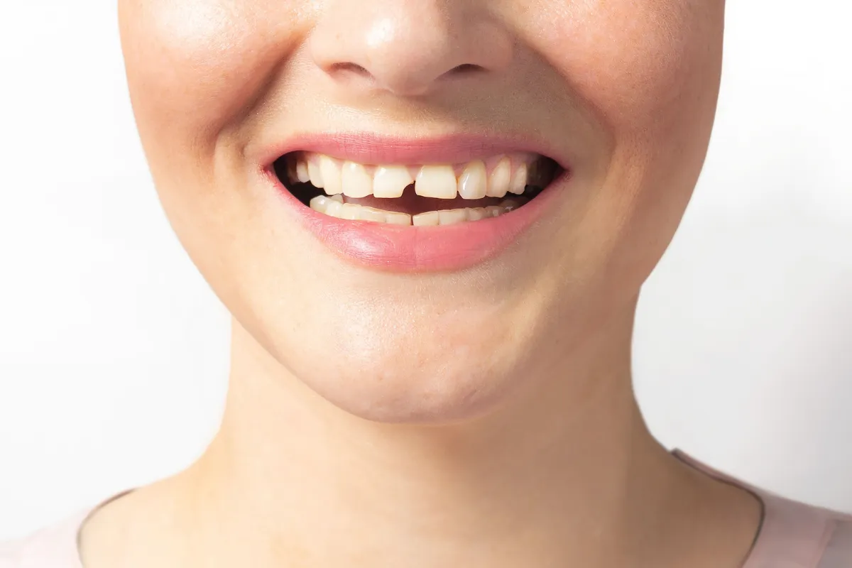 Dente scheggiato: cause, sintomi e soluzioni efficaci
