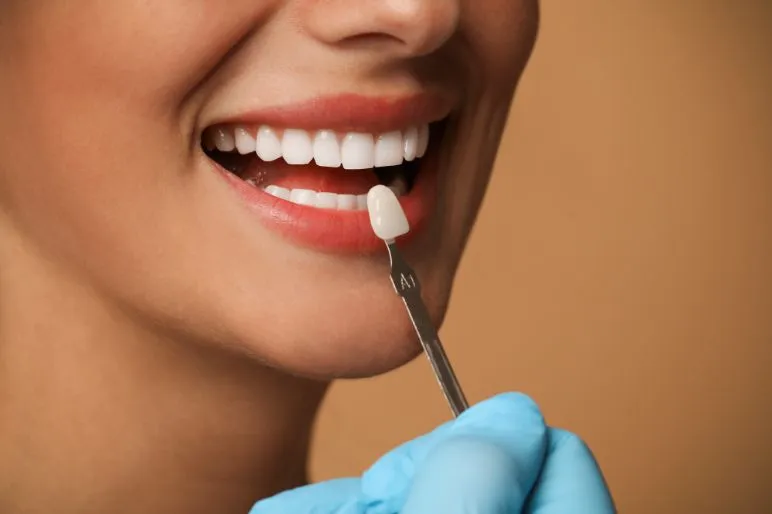 Denti con faccette: trasforma il sorriso in modo naturale